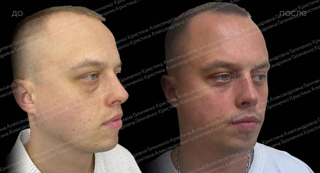 Нижняя трансконъюнктивальная блефаропластика