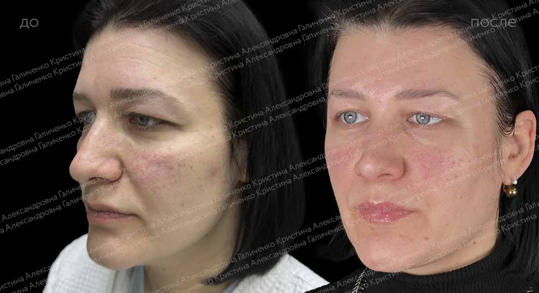Верхняя блефаропластика + подтяжка лба и висков