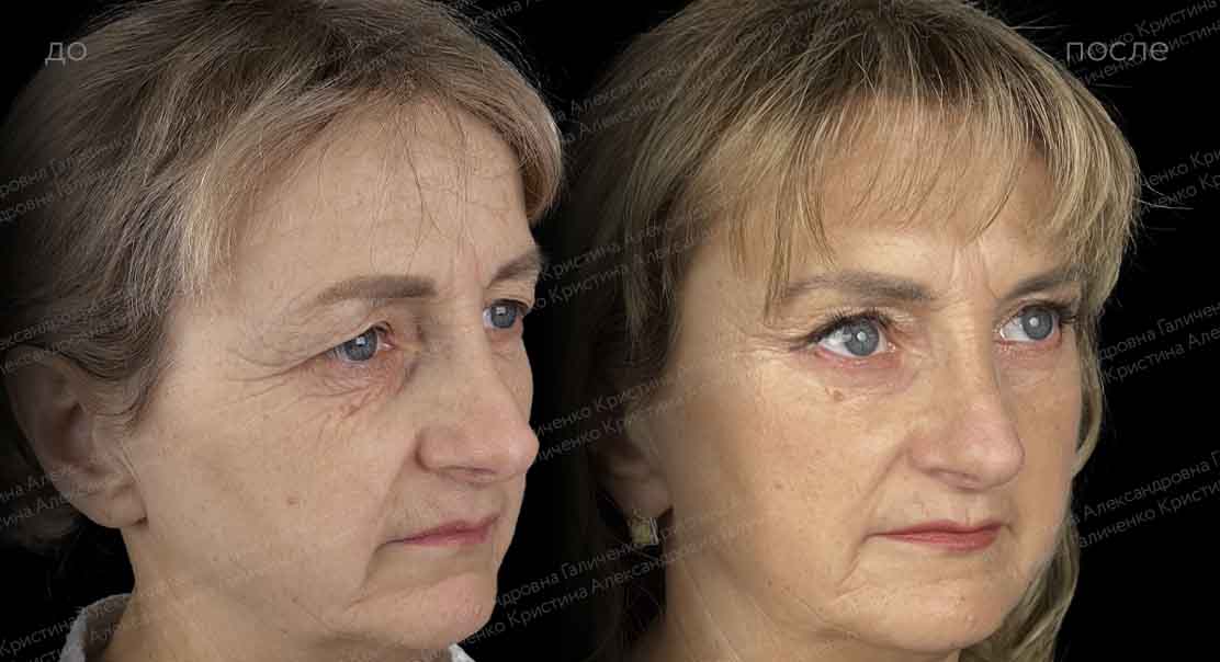 Эндоскопический лобно-височный лифтинг + круговая блефаропластика