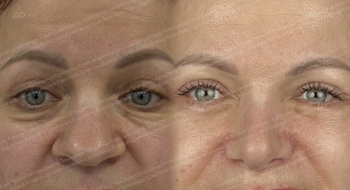 Нижняя блефаропластика с миопексией