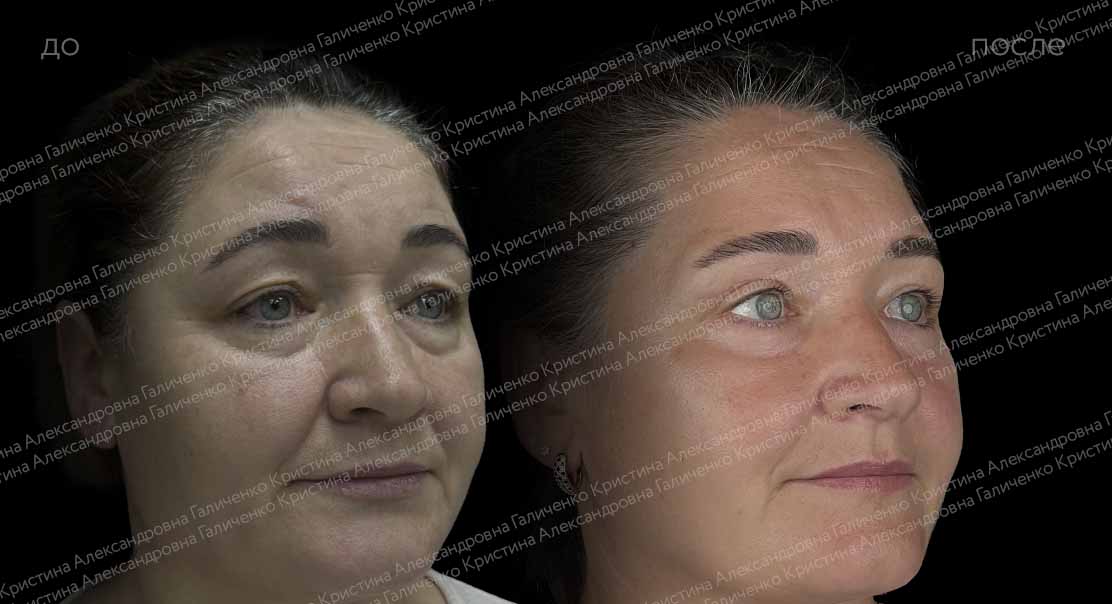 Пластика верхних и нижних век + миопексия
