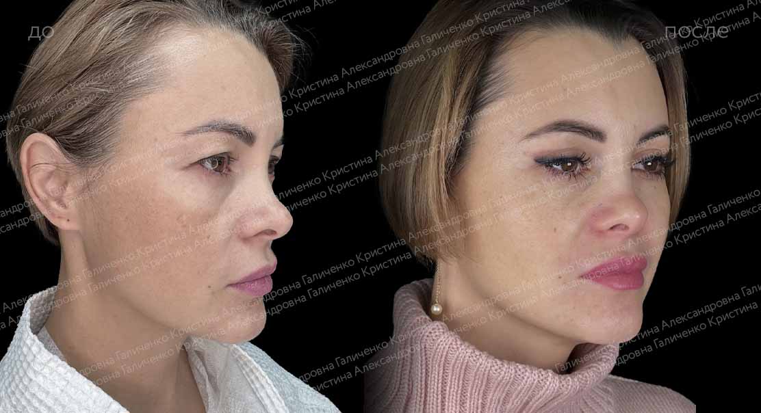 Верхняя блефаропластика