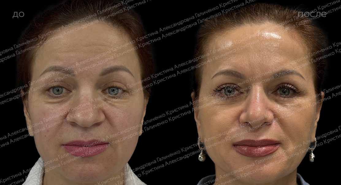 Нижняя блефаропластика с миопексией