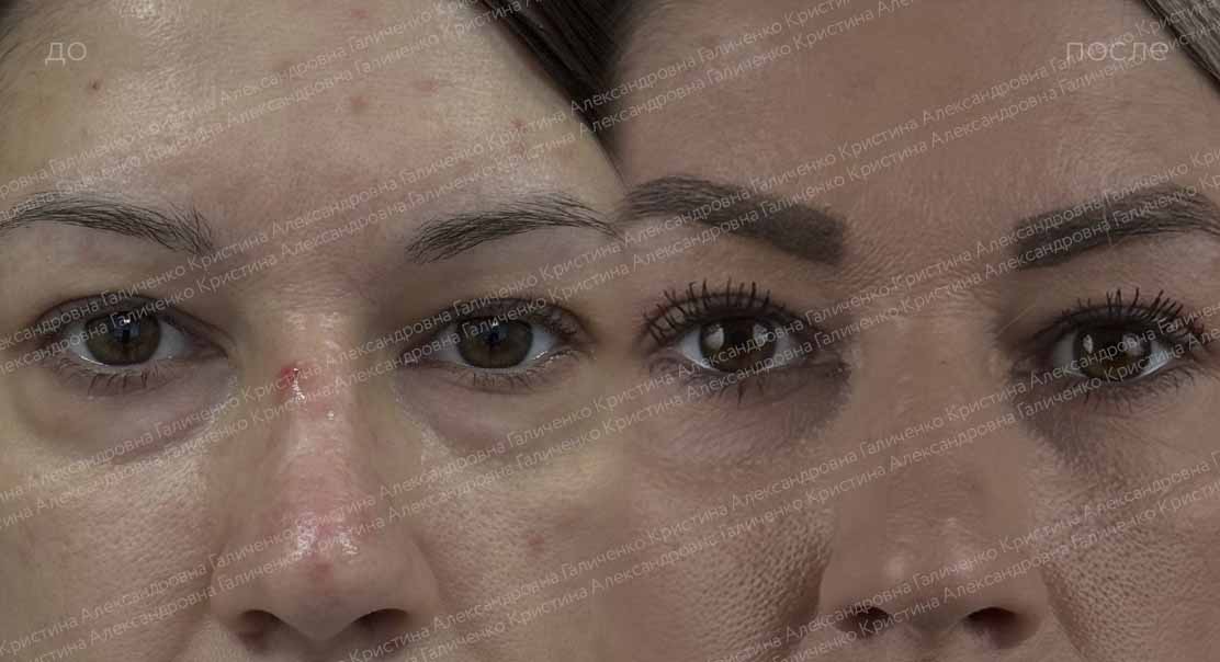 Нижняя блефаропластика