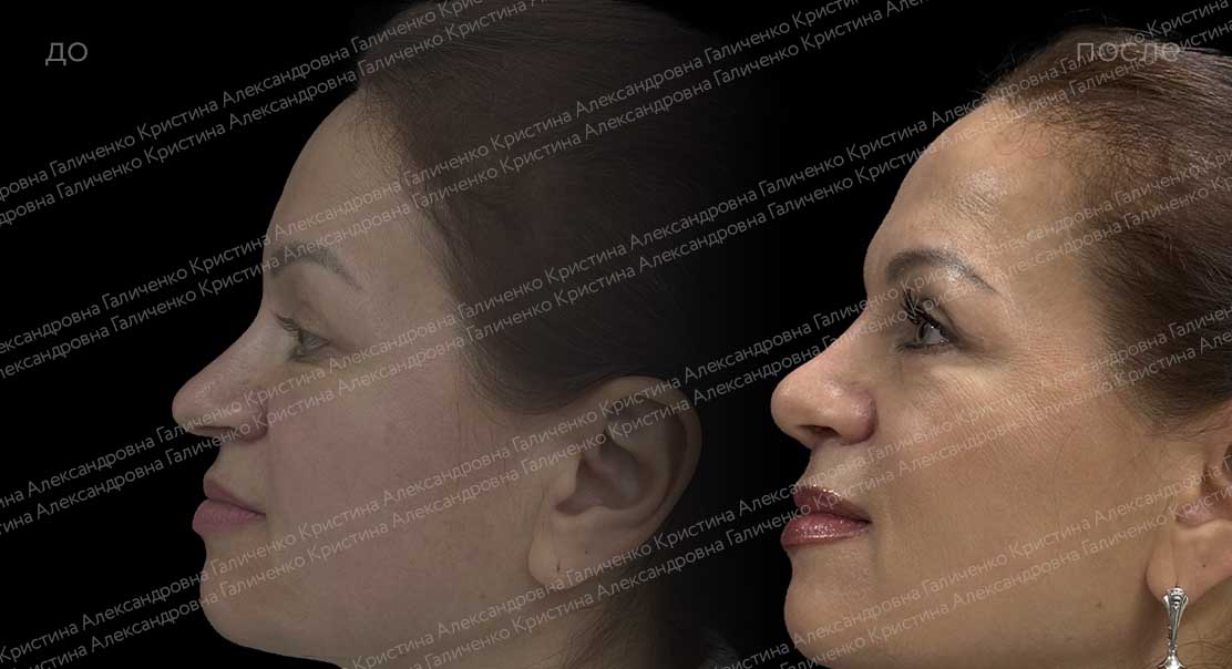 Нижняя блефаропластика с миопексией
